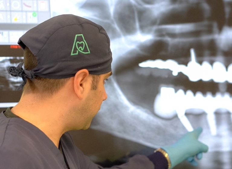 Blog 1 cosa fare dopo un impianto dentale a Verona
