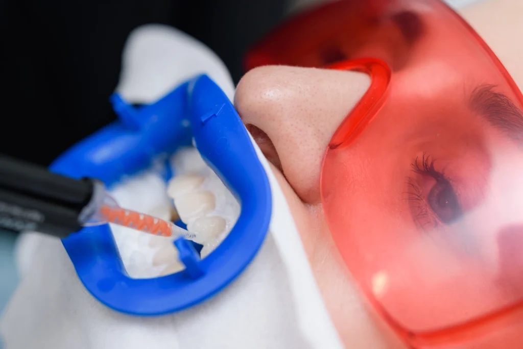 Come funziona lo sbiancamento dentale dal dentista 2 sbiancamento dentale dal dentista